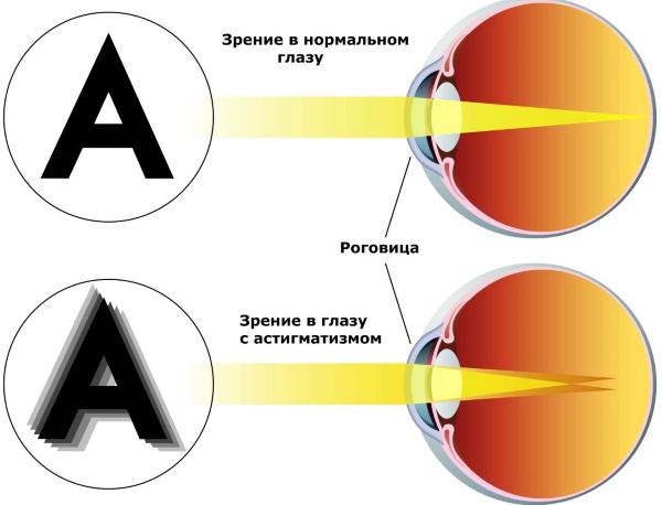 Коррекция зрения при астигматизме, близорукости, дальнозоркости. Отзывы