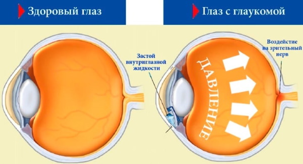 Коррекция зрения при астигматизме, близорукости, дальнозоркости. Отзывы