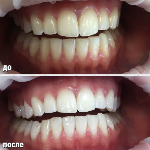 Косметическое отбеливание зубов. Отзывы