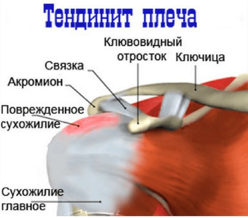 Малая круглая мышца плеча. Анатомия, функции, болит, симптомы, как лечить