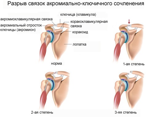 Малая круглая мышца плеча. Анатомия, функции, болит, симптомы, как лечить