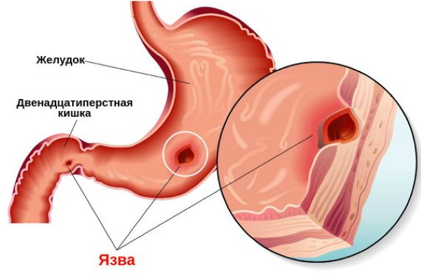 Лучшие препараты от анемии для женщин, мужчин. Отзывы врачей