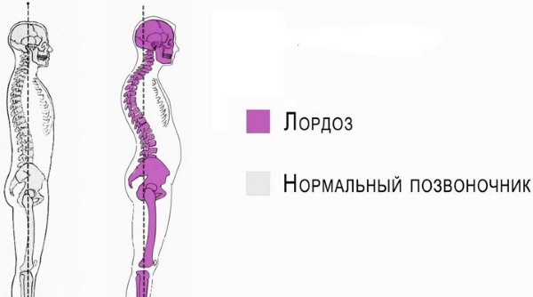 Прогиб в пояснице у девушки. Что это, упражнения, как убрать лордоз