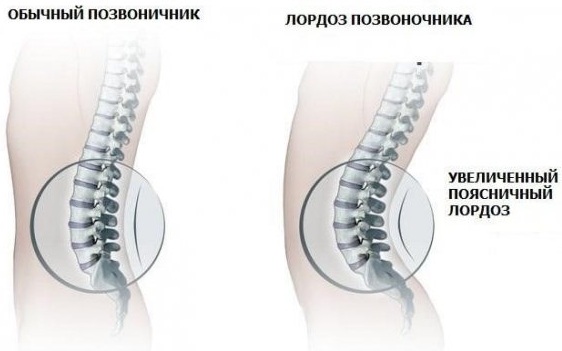 Прогиб в пояснице у девушки. Что это, упражнения, как убрать лордоз