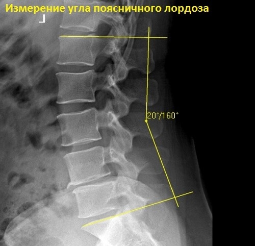 Прогиб в пояснице у девушки. Что это, упражнения, как убрать лордоз