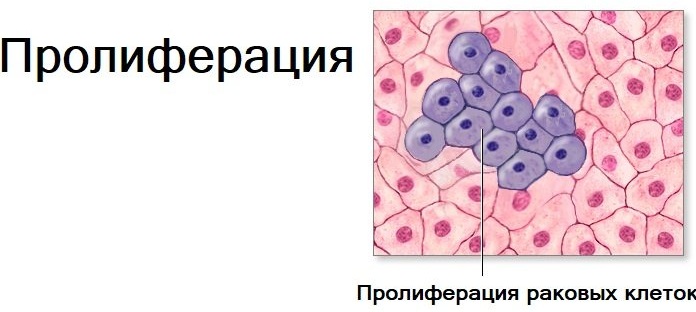 Пролиферация в гинекологии. Что это, хорошо или плохо, железистого эпителия, при полипе у женщин