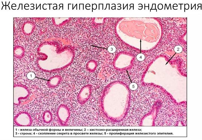 Пролиферация в гинекологии. Что это, хорошо или плохо, железистого эпителия, при полипе у женщин