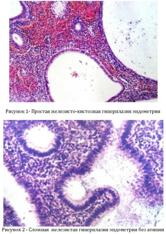 Пролиферация в гинекологии. Что это, хорошо или плохо, железистого эпителия, при полипе у женщин
