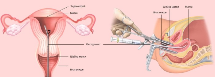 Пролиферация в гинекологии. Что это, хорошо или плохо, железистого эпителия, при полипе у женщин