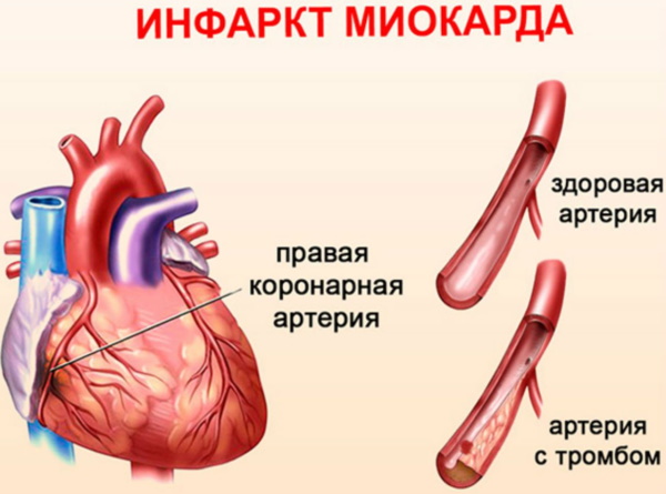 Розувастатин, аналоги и заменители препарата. Отзывы