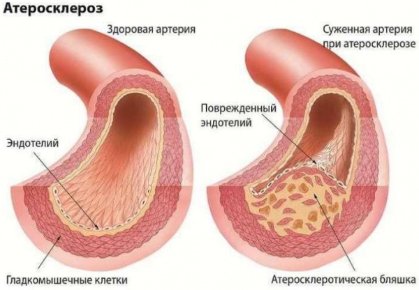 Розувастатин, аналоги и заменители препарата. Отзывы