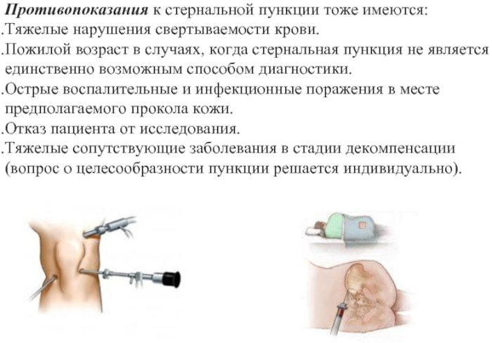 Стернальная пункция. Что это, проводится при диагностике чего, алгоритм