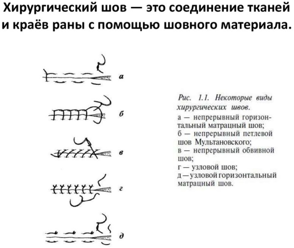 Виды швов хирургия фото