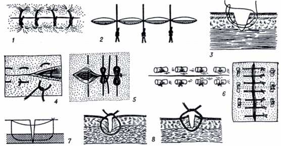 Виды швов хирургия фото