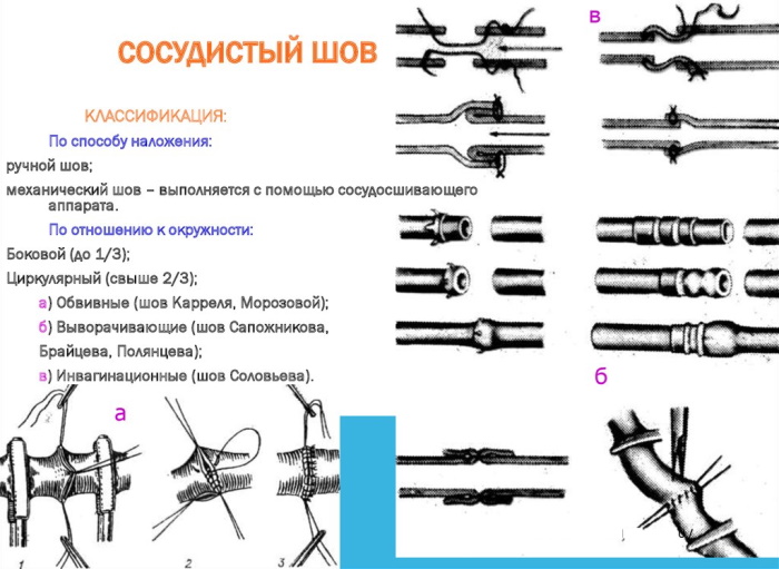 Виды швов хирургия фото