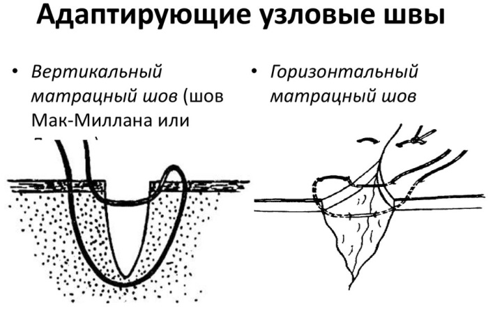 Виды швов хирургия фото