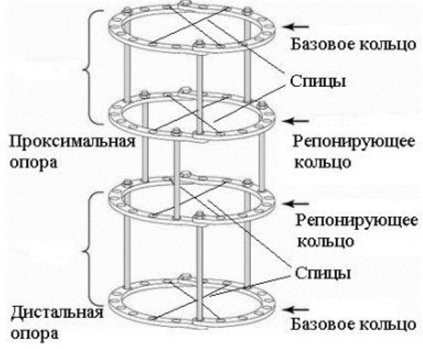 Аппарат Илизарова на ноге, руке, бедре. Установка, фото как, сколько носить, ухаживать