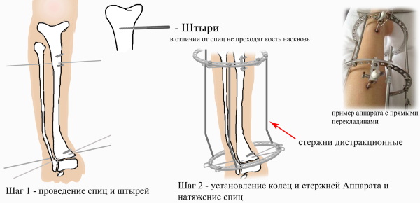 Аппарат Илизарова на ноге, руке, бедре. Установка, фото как, сколько носить, ухаживать