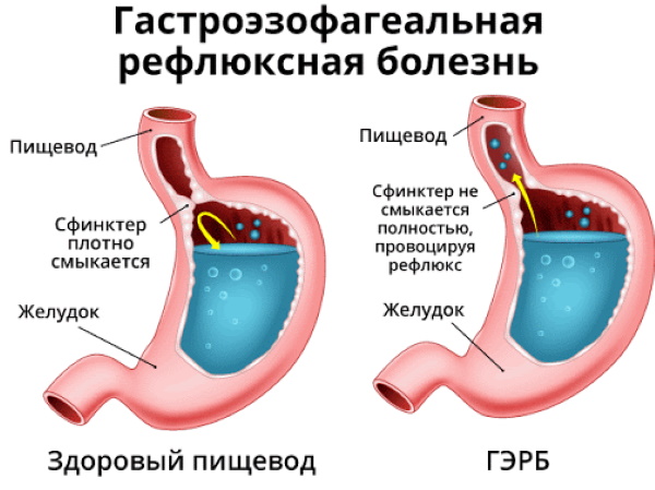 Густая слюна во рту. Причины у ребенка, взрослого