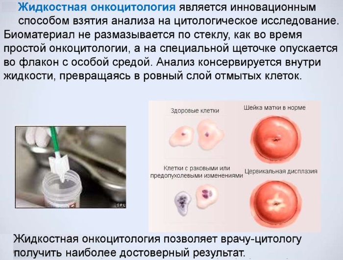 Жидкостная онкоцитология шейки матки. Что это такое, подготовка к процедуре, как делают