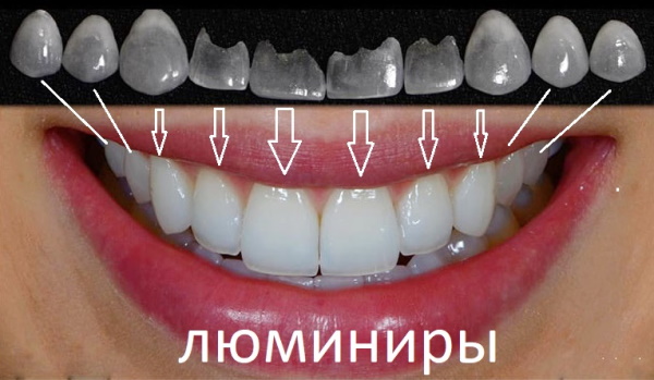 Люминиры на зубы. Цена с установкой, что это такое, минусы, плюсы, отзывы