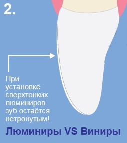 Люминиры на зубы. Цена с установкой, что это такое, минусы, плюсы, отзывы