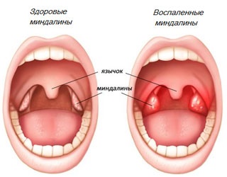 Удаление миндалин лазером. Цена, отзывы