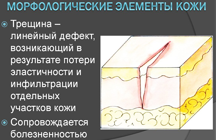 Морфологические элементы кожи первичные и вторичные. Таблица