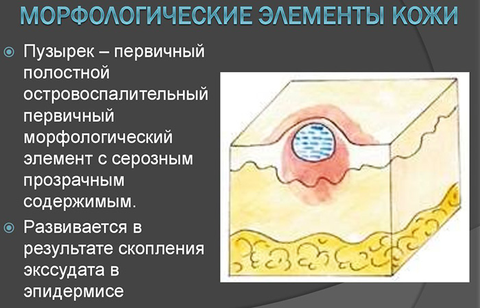 Морфологические элементы кожи первичные и вторичные. Таблица