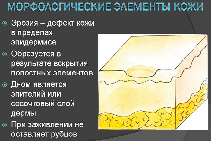 Морфологические элементы кожи первичные и вторичные. Таблица