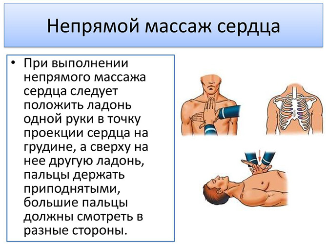 Непрямой массаж сердца. Как проводится, частота нажатий в минуту, глубина продавливания грудной клетки