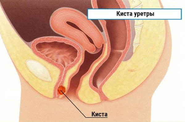 Парауретральные железы у женщин, мужчин. Что это такое, где находятся, функции