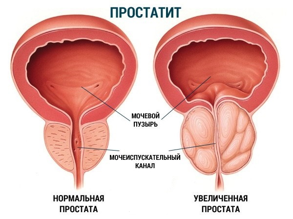 Парауретральные железы у женщин, мужчин. Что это такое, где находятся, функции