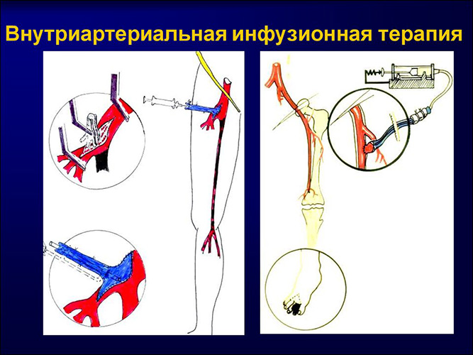 Парентеральный способ введения лекарственных средств в организм