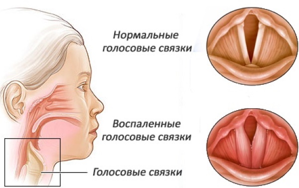 Как сделать физраствор в домашних условиях для промывания носа, ингаляций