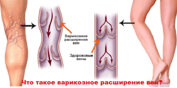 Сводит икроножную мышцу по ночам. Причины, что делать