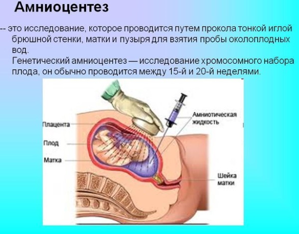 Трисомия 18 (Синдром Эдвардса). Нормальные показатели в 12-13-14 недель