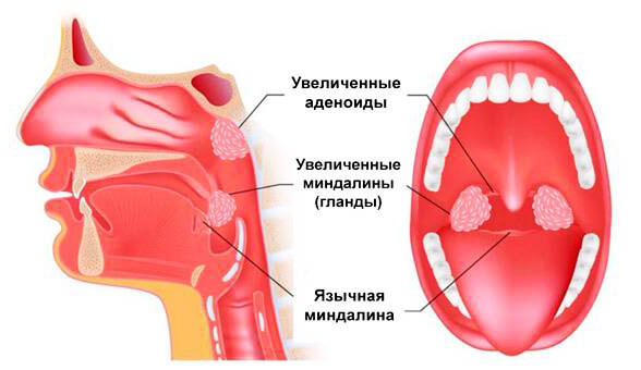 Удаление миндалин лазером. Цена, отзывы