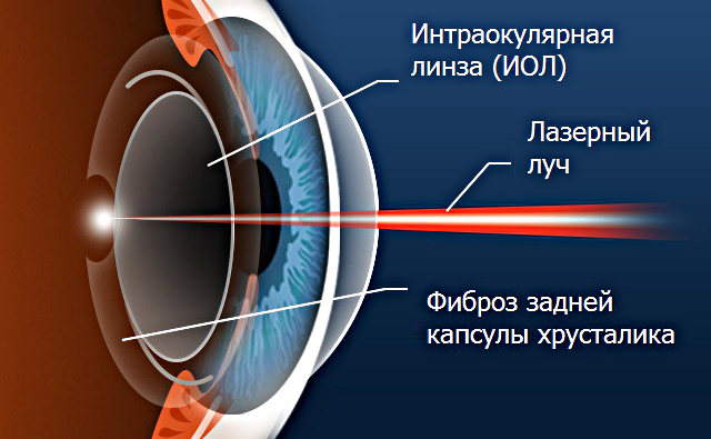 Вторичная катаракта. Лечение лазером, цена, отзывы