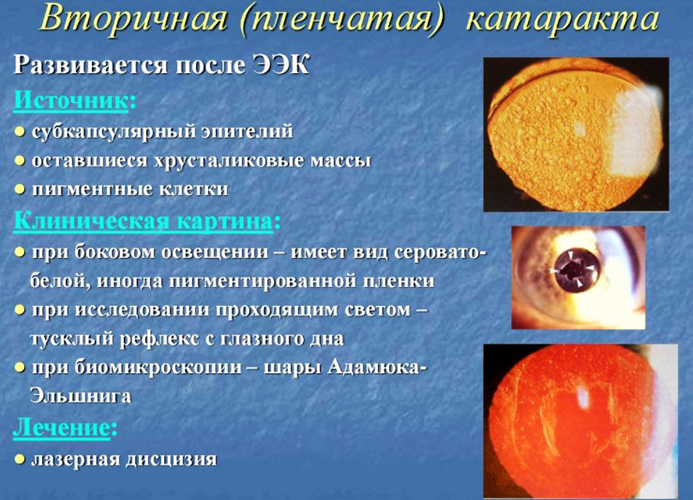 Вторичная катаракта. Лечение лазером, цена, отзывы