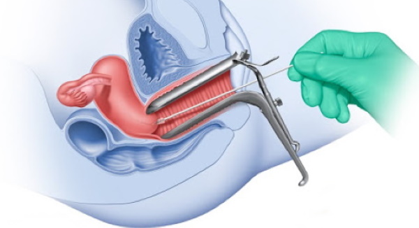 Жидкостная онкоцитология шейки матки. Что это такое, подготовка к процедуре, как делают