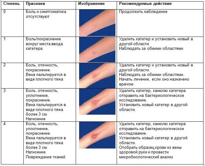 Схема постановки внутривенного катетера