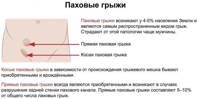 Бандажи для паховой грыжи мужские левосторонние, правосторонние, как пользоваться