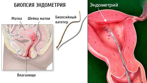 Пайпель-биопсия эндометрия. Что это такое, расшифровка результатов, цена