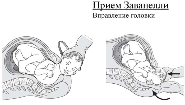 Дистоция плечиков в родах. Что это такое, причины, последствия для ребенка