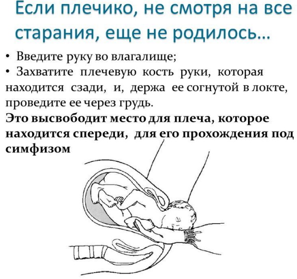 Дистоция плечиков в родах. Что это такое, причины, последствия для ребенка