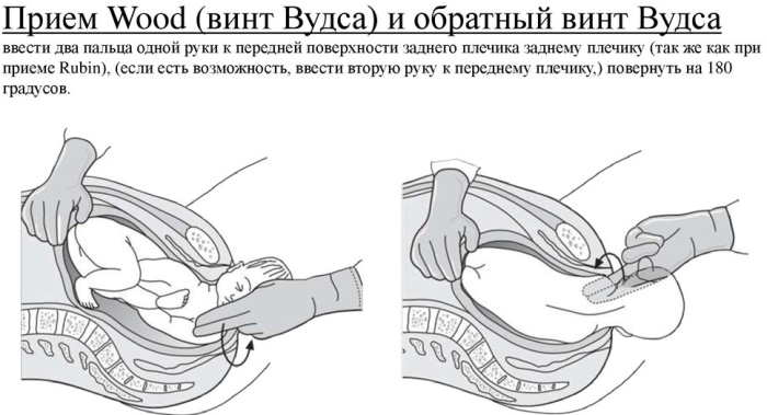 Дистоция плечиков в родах. Что это такое, причины, последствия для ребенка