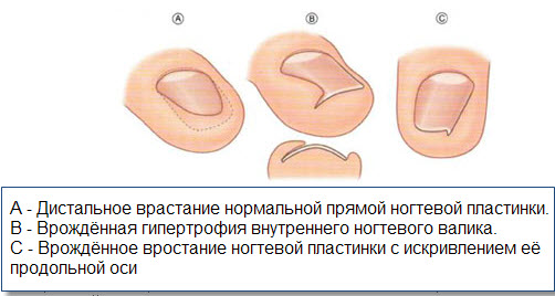 Лазерная коррекция ногтя на ноге, руке, вросшего. Что это такое, как делают, цена