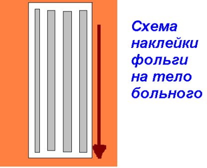 Лечение фольгой. Показания и противопоказания, отзывы