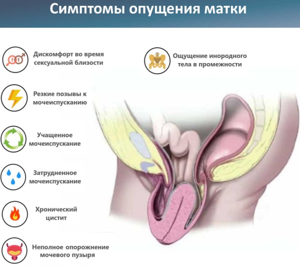 Опущение задней стенки матки. Симптомы и лечение